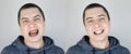 Before and after. The man shows the damaged teeth by caries, and in the second picture the dentist`s work on the restoration of