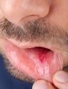 Man shows his lower lip with aphtha Royalty Free Stock Photo