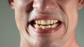 The man shows his yellow crooked and protruding teeth. Malocclusion. Close-up