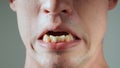 The man shows his yellow crooked and protruding teeth. Malocclusion. Close-up