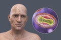 A man with smallpox disease and close-up view of variola virus, a virus from Orthopoxviridae family that causes smallpox