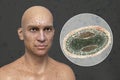 A man with smallpox disease and close-up view of variola virus, a virus from Orthopoxviridae family that causes smallpox