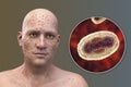 A man with smallpox disease and close-up view of variola virus, a virus from Orthopoxviridae family that causes smallpox