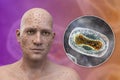 A man with smallpox disease and close-up view of variola virus, a virus from Orthopoxviridae family that causes smallpox