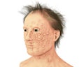 A man with smallpox infection and variola virus, a virus from Orthopoxviridae family that causes smallpox