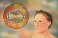 A man with smallpox infection and variola virus, a virus from Orthopoxviridae family that causes smallpox