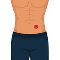 Man with stoma after colon cancer surgery Royalty Free Stock Photo