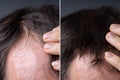 Man Before And After Hair Loss Treatment Royalty Free Stock Photo