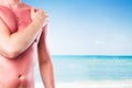 Man with a sunburn Royalty Free Stock Photo