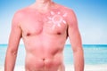 Man with a sunburn Royalty Free Stock Photo