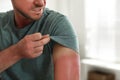 Man with sunburned skin at home Royalty Free Stock Photo