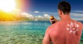 Man with sunburned skin Royalty Free Stock Photo