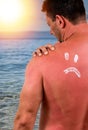 Man with sunburned skin Royalty Free Stock Photo