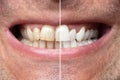 Man Teeth Before And After Whitening Royalty Free Stock Photo