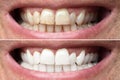 Man Teeth Before And After Whitening Royalty Free Stock Photo