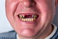 A man without upper front teeth. Inserting teeth Royalty Free Stock Photo