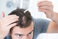Man using hair loss treatment on his scalp Royalty Free Stock Photo