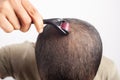 Man using Microneedling on visible bald scalp for new hair regrowth Royalty Free Stock Photo