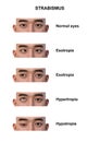 A man with various strabismus types, 3D illustration