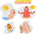 Man with a very bad sunburn Royalty Free Stock Photo