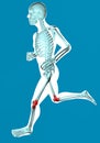 Man walking seen on x-ray with pain in knees Royalty Free Stock Photo