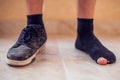 Man wearing holey sock and dirty shoes. Poorness and untidiness concept