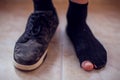 Man wearing holey sock and dirty shoes. Poorness and untidiness concept