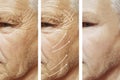 Man, wrinkles on face, correction cosmetology difference patient before and after procedures Royalty Free Stock Photo