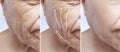 Man, wrinkles on face, correction difference patient before and after procedures Royalty Free Stock Photo