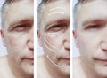 Man, wrinkles on face, correction patient before and after procedures Royalty Free Stock Photo