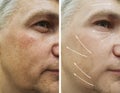 Man, wrinkles on face before and after dermatology therapy procedures Royalty Free Stock Photo