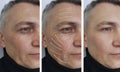 Man wrinkles on the face before and after removal procedures, arrow Royalty Free Stock Photo