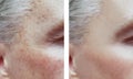 Man wrinkles before and after procedures, acne pigmentation