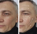 Man wrinkles before and after removal aging procedures dermatology medicine Royalty Free Stock Photo