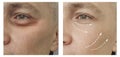 Man wrinkles before and after surgery removal aging procedures dermatology medicine Royalty Free Stock Photo