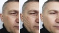 Man skin wrinkles on the face before and after dermatology removal procedures, arrow Royalty Free Stock Photo