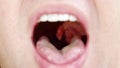 a man's mouth close-up. the palatine uvula and mucous membrane of the throat.