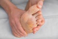 Man& x27;s peeling and cracked feet. Fungal infection, eczema, psoriasis, sweaty feet