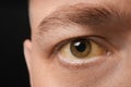 Man with yellow eyes on black background. Liver problems symptom