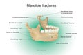 Mandible fractures Royalty Free Stock Photo