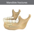 Mandible fractures is the largest, strongest and lowest bone in