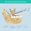 Mandibular Nerve Block.