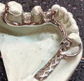 Mandibular partial denture