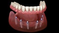 Mandibular prosthesis All on 6 system supported by implants