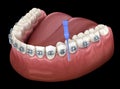 Mandibular prosthesis All on 8 system supported by implants. Royalty Free Stock Photo