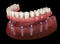 Mandibular prosthesis All on 8 system supported by implants. Medically accurate 3D illustration of human teeth Royalty Free Stock Photo