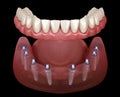 Mandibular prosthesis All on 8 system supported by implants. Medically accurate 3D illustration of human teeth