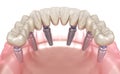 Mandibular prosthesis All on 6 system supported by implants. Medically accurate 3D illustration of human teeth Royalty Free Stock Photo