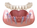 Mandibular prosthesis All on 6 system supported by implants. Medically accurate 3D illustration of human teeth Royalty Free Stock Photo