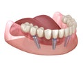 Mandibular prosthesis All on 4 system supported by implants. Medically accurate 3D illustration of human teeth